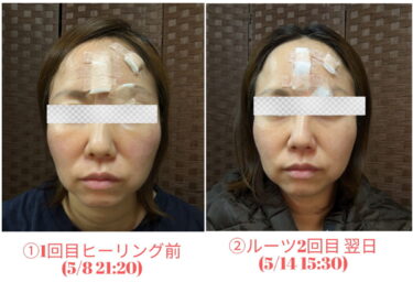 ヒーリングを受ける前の顔と4回のヒーリング（最終ルーツ2回）を受けた後6日後