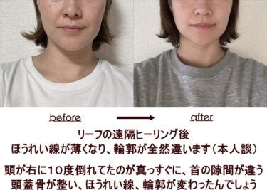 遠隔ヒーリングなのに、ほうれい線が薄くなり、輪郭が全然違います、と本人談のビフォーアフター写真